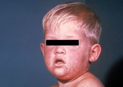 Rougeole : la vaccination est fortement recommandée
